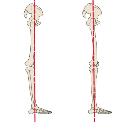 Hiperextensión de rodilla: información y recomendaciones